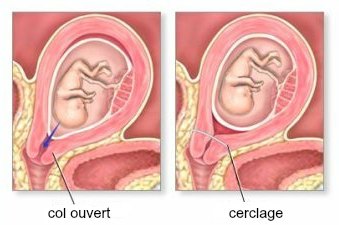 grossesse cerclage 2