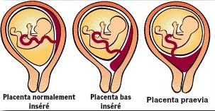 grossesse placenta praevia 2