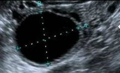 Quels sont les médicaments utilisés dans la stimulation de l'ovulation