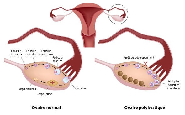 Le syndrome des ovaires polykystiques