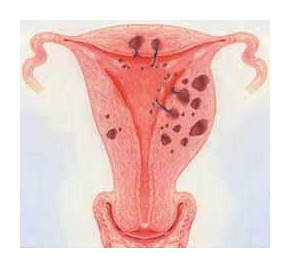 Endométriose et fertilité