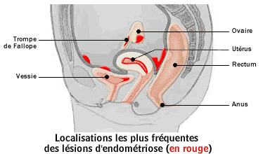 Localisations et symptômes de l'endométriose