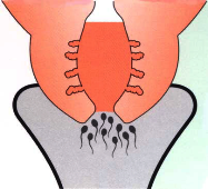 glaire cervicale patho