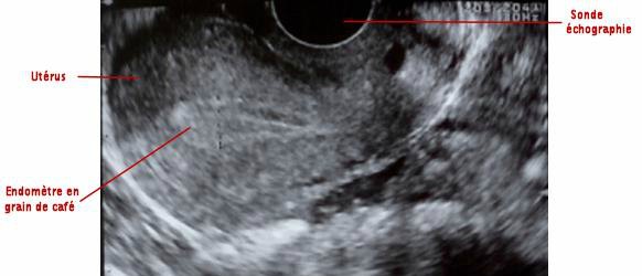 monitorage endometre